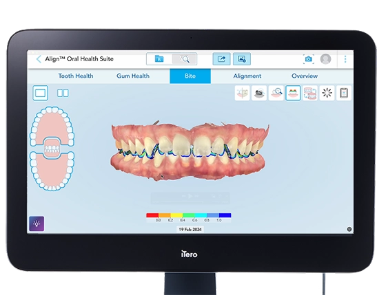 Manufacturer example of an iTero bite contact visualization