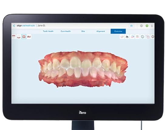 Manufacturer example of an iTero Oral Health Suite 3D overview of teeth and gums